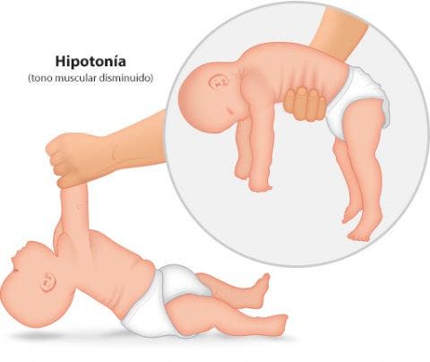 Que es una hipertonia muscular